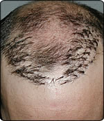 hairtransplantrepair1.jpg